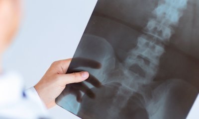 Osteoporosi, se ne parla in un convegno a Savigliano