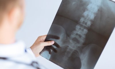 Prevenire e curare l’osteoporosi: un convegno a Ceva