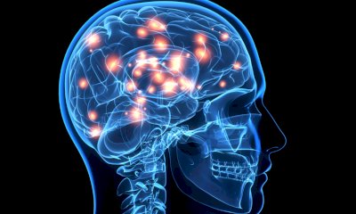 Ictus acuto: Azienda Zero mette in campo il progetto per condividere le immagini radiologiche