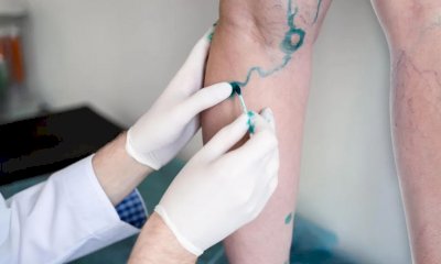 Al via la Vein Week in Asl CN1: una settimana dedicata alla prevenzione delle malattie venose e linfatiche