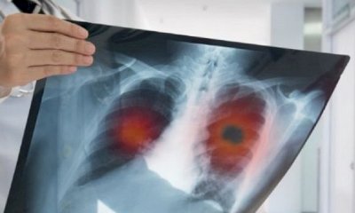 Un open day per lo screening polmonare con la Fondazione Ospedale di Cuneo