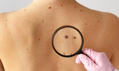 Innovazione e approccio multimediale nei tumori cutanei non melanoma: se ne discute a Fossano e Cuneo