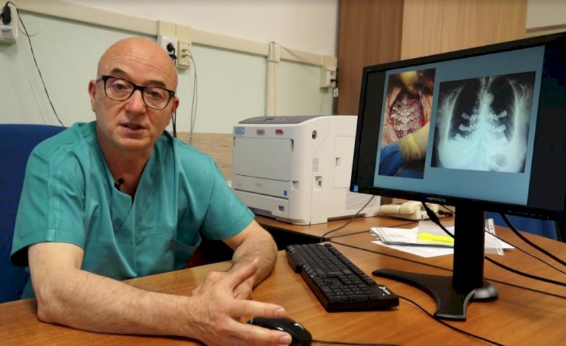 Impiantata per la prima volta all'ospedale di Cuneo una protesi allo sterno su misura da immagini Tac