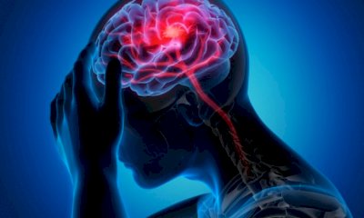 Combattere l'emicrania con l'esercizio: una terapia efficace per giovani adulti