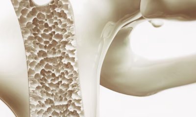 Osteoporosi ed esercizio fisico: un connubio essenziale per la salute delle ossa