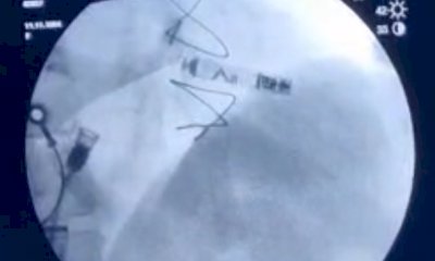 All'ospedale di Mondovì si impiantano pacemaker 